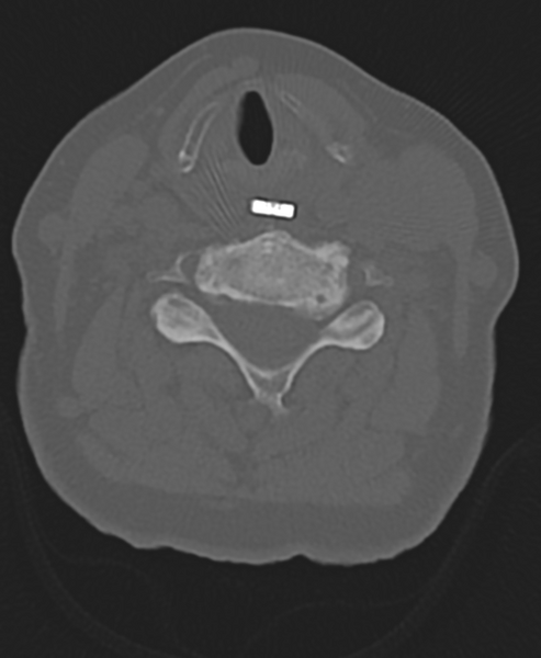 File:Cervical spine ACDF loosening (Radiopaedia 48998-54071 Axial bone window 35).png