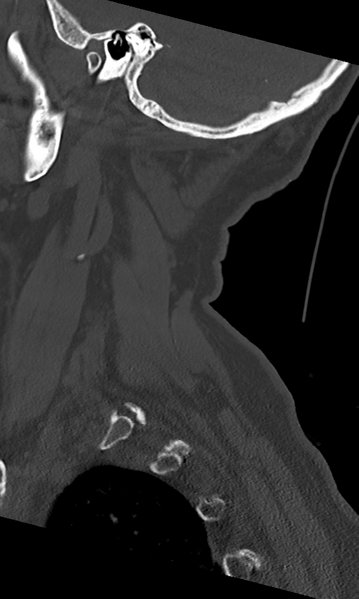 File:Cervical spine fracture - chalk stick (Radiopaedia 39116-41323 Sagittal bone window 10).png