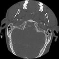 Cervical spine fractures with vertebral artery dissection (Radiopaedia 32135-33078 Axial bone window 74).jpg