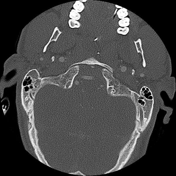 File:Cervical spine fractures with vertebral artery dissection (Radiopaedia 32135-33078 Axial bone window 74).jpg
