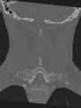 Cervical spondylolysis (Radiopaedia 49616-54811 Coronal bone window 36).png