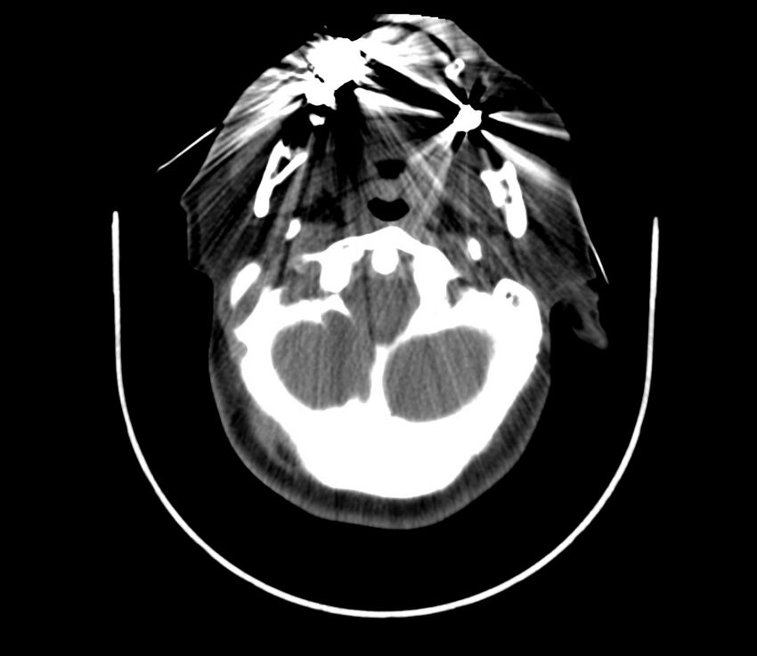 Cervical venous malformation (Radiopaedia 22653-22672 Axial non-contrast 19).jpg