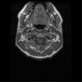 Cervical vertebrae metastasis (Radiopaedia 78814-91667 Axial T1 7).png