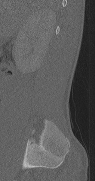 File:Chance fracture (Radiopaedia 40360-42912 Sagittal bone window 87).png