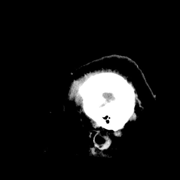 File:Chiasmatic-hypothalamic juvenile pilocytic astrocytoma (Radiopaedia 78533-91237 B 56).jpg