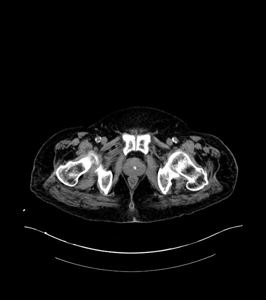 File:Cholangiocarcinoma with cerebral metastases (Radiopaedia 83519-98629 Axial non-contrast 127).jpg