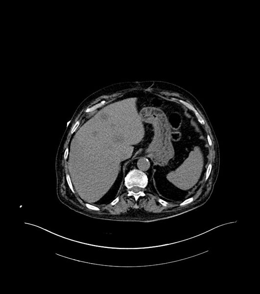 File:Cholangiocarcinoma with cerebral metastases (Radiopaedia 83519-98629 Axial non-contrast 17).jpg