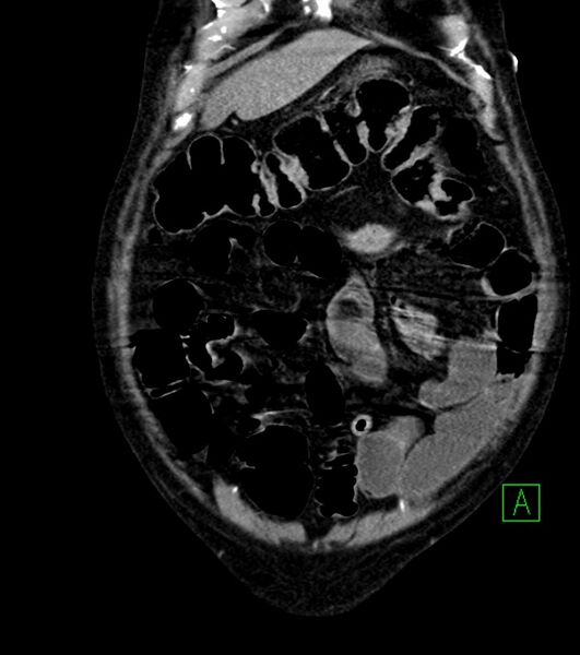 File:Cholangiocarcinoma with cerebral metastases (Radiopaedia 83519-98629 E 19).jpg