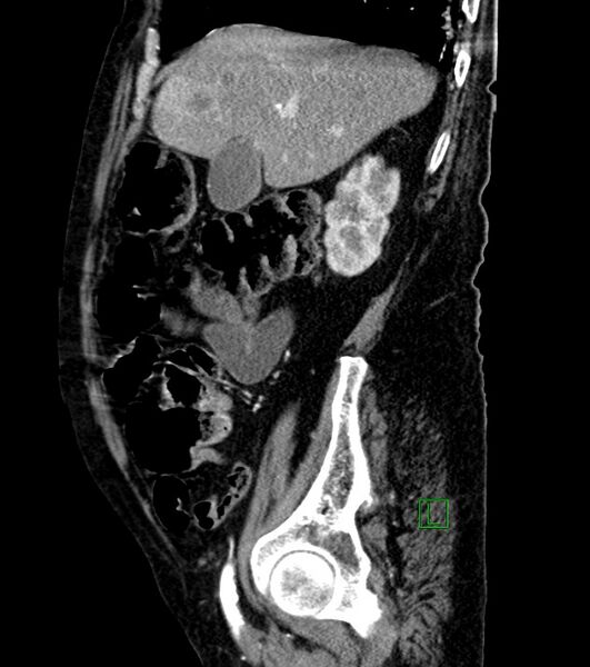 File:Cholangiocarcinoma with cerebral metastases (Radiopaedia 83519-98629 F 87).jpg