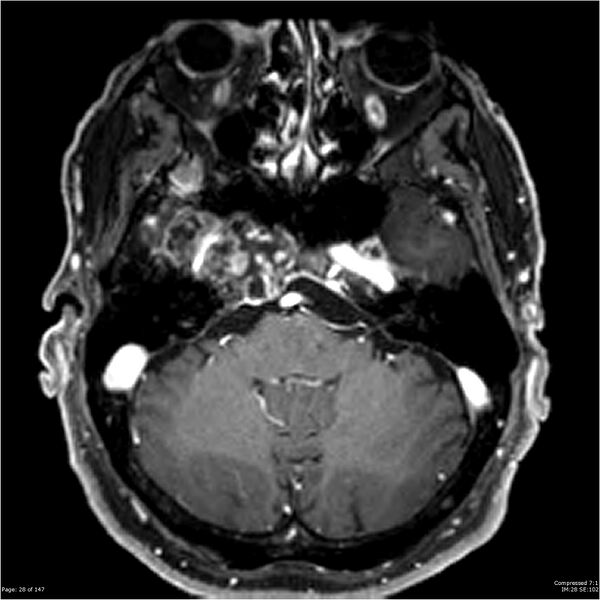 File:Chondrosarcoma of skull base- grade II (Radiopaedia 40948-43654 Axial T1 C+ 16).jpg