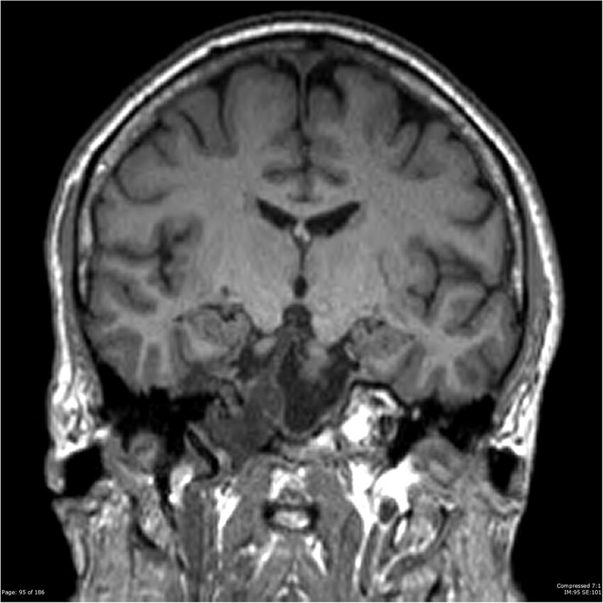 Chondrosarcoma of skull base- grade II (Radiopaedia 40948-43654 Coronal T1 16).jpg