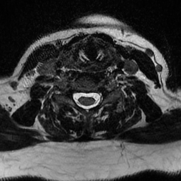 File:Chordoma - cervical spine (Radiopaedia 70084-80111 Axial T2 61).png