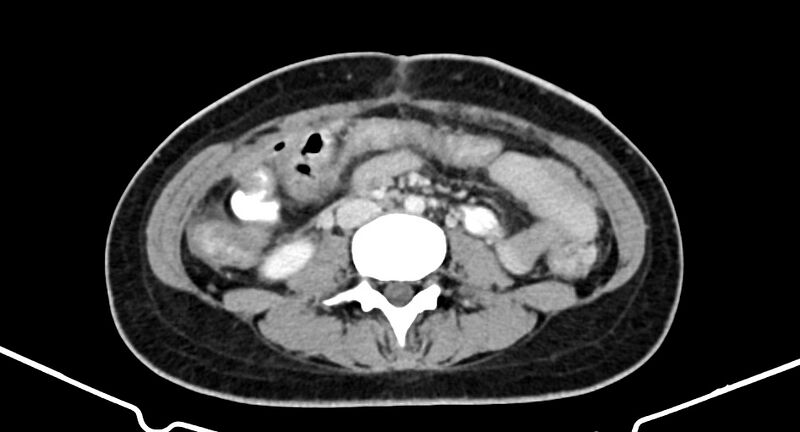 File:Choriocarcinoma liver metastases (Radiopaedia 74768-85766 A 121).jpg