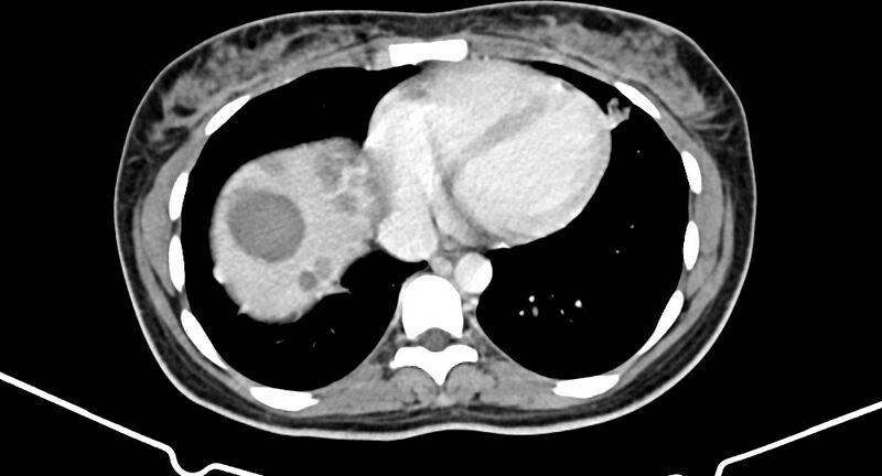 File:Choriocarcinoma liver metastases (Radiopaedia 74768-85766 A 18).jpg