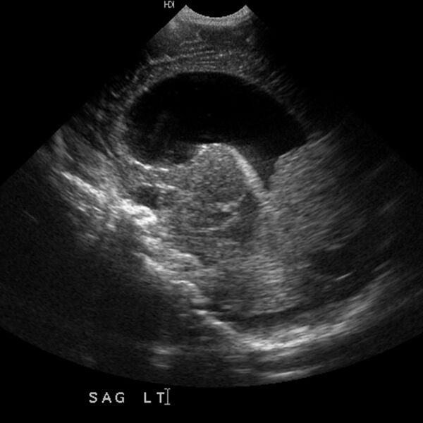 File:Choroid plexus carcinoma (Radiopaedia 21121-21033 A 11).jpg