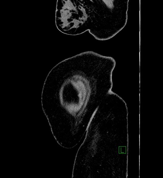 File:Chromophobe renal cell carcinoma (Radiopaedia 84239-99519 G 3).jpg