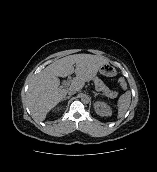 File:Chromophobe renal cell carcinoma (Radiopaedia 84337-99693 Axial non-contrast 34).jpg