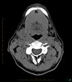 Chronic Submandibular sialolithiasis (Radiopaedia 16880-16606 Axial non-contrast 18).jpg