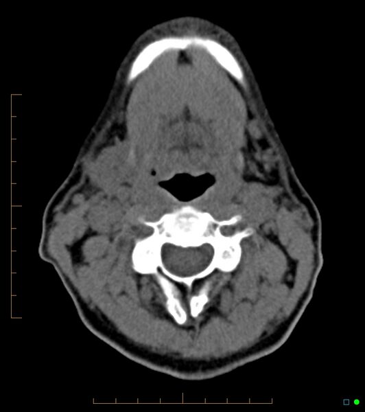 File:Chronic Submandibular sialolithiasis (Radiopaedia 16880-16606 Axial non-contrast 18).jpg