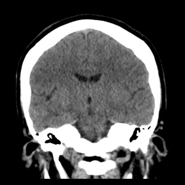 File:Chronic bilateral occipital lobe infarcts (Radiopaedia 31276-31996 Coronal non-contrast 26).jpg