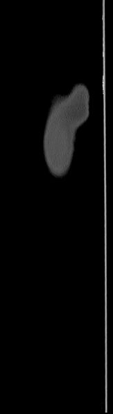 File:Chronic osteomyelitis (with sequestrum) (Radiopaedia 74813-85822 C 110).jpg