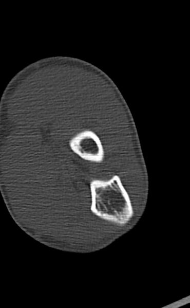 File:Chronic osteomyelitis of the distal humerus (Radiopaedia 78351-90971 Axial bone window 105).jpg