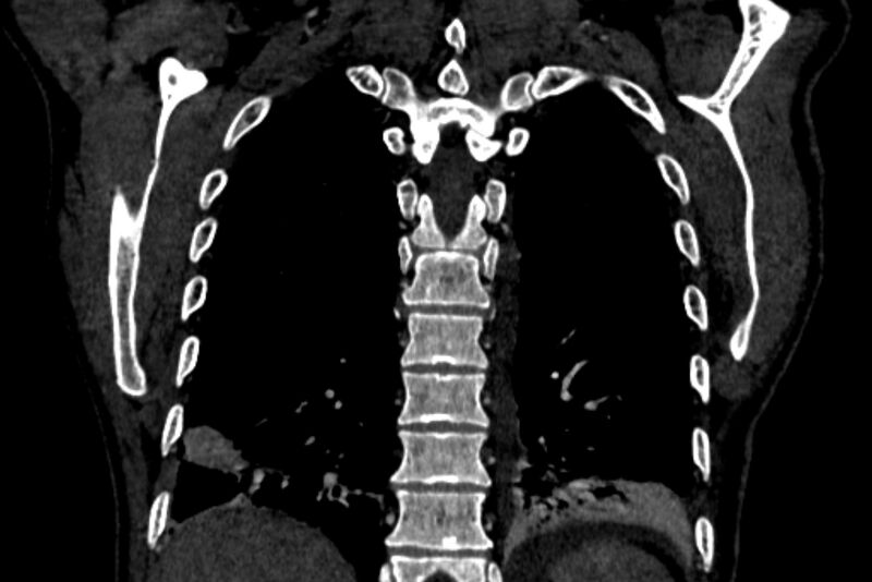 File:Chronic pulmonary embolism with bubbly consolidation (Radiopaedia 91248-108850 B 115).jpg
