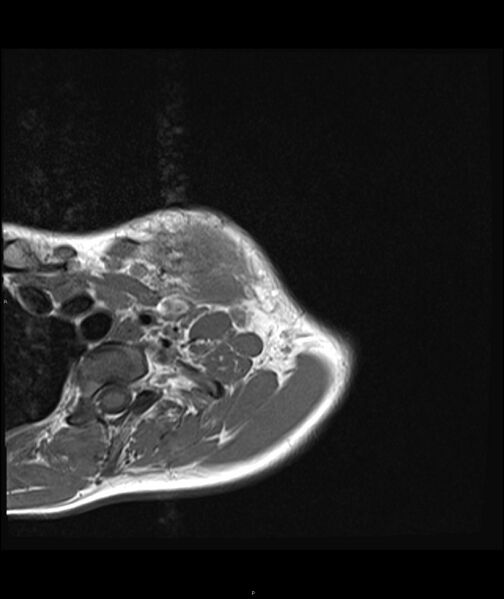 File:Chronic reactive multifocal osteomyelitis (CRMO) - clavicle (Radiopaedia 56406-63071 Axial T1 5).jpg