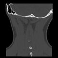 Clay-shoveler fracture (Radiopaedia 22568-22590 Coronal bone window 39).jpg