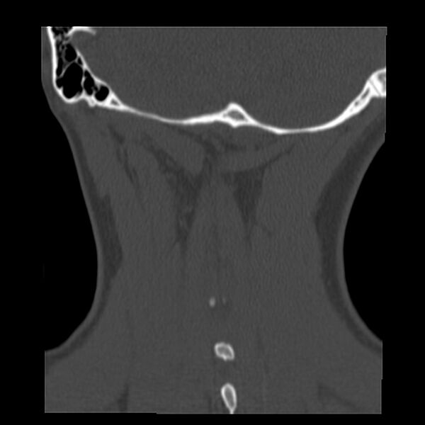 File:Clay-shoveler fracture (Radiopaedia 22568-22590 Coronal bone window 39).jpg