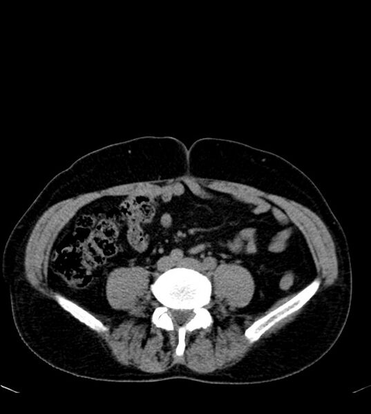 File:Clear cell renal cell carcinoma (Radiopaedia 85006-100539 Axial non-contrast 57).jpg