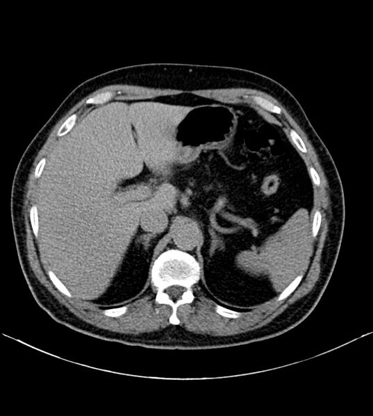 File:Clear cell renal cell carcinoma (Radiopaedia 85006-100539 H 3).jpg
