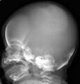 Cleidocranial dysostosis (Radiopaedia 11319-11683 C 1).jpg