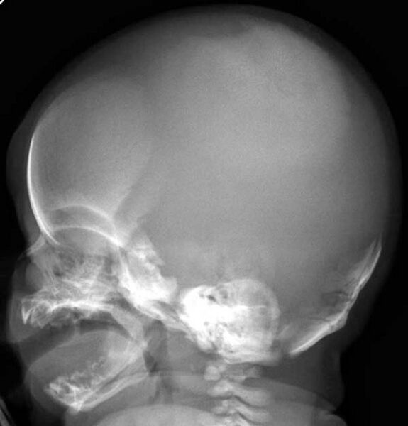 File:Cleidocranial dysostosis (Radiopaedia 11319-11683 C 1).jpg