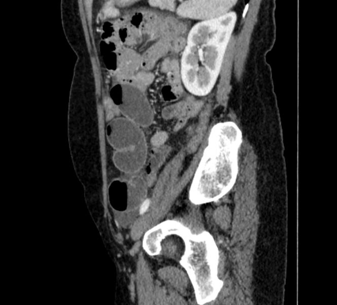 File:Closed loop small bowel obstruction (Radiopaedia 71211-81508 C 123).jpg