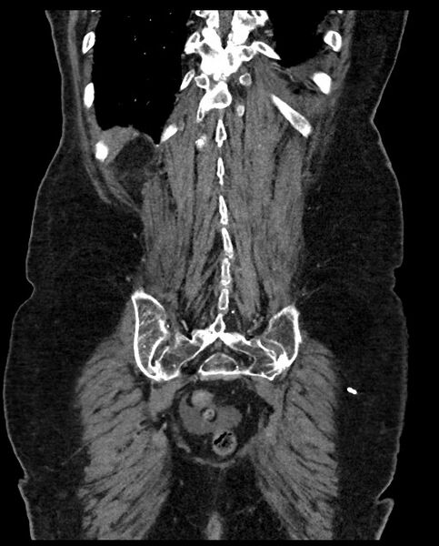 File:Closed loop small bowel obstruction - adhesions (Radiopaedia 59269-66611 B 106).jpg