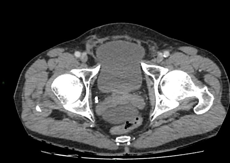 File:Closed loop small bowel obstruction with ischemia (Radiopaedia 84180-99456 A 114).jpg