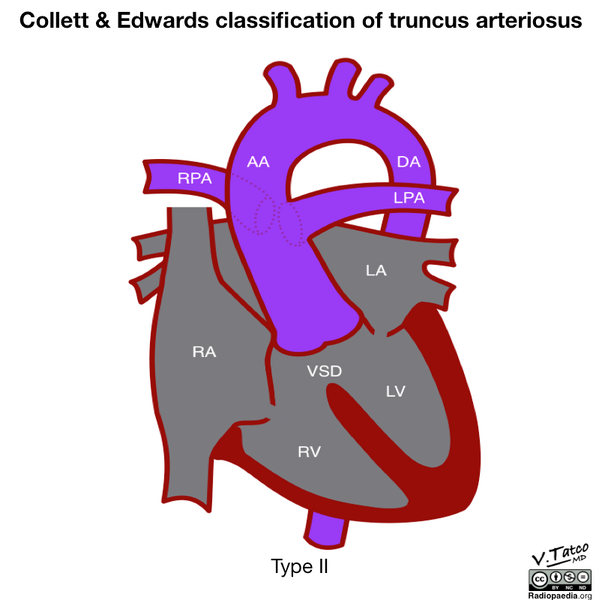 File:Collett and Edwards classification of truncus arteriosus (diagram) (Radiopaedia 51895-57733 C 1).png