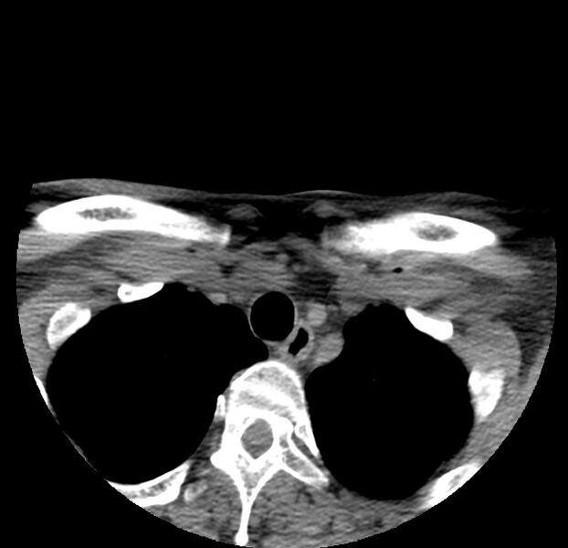 File:Colloid cyst of thyroid (Radiopaedia 22897-22923 Axial non-contrast 52).jpg
