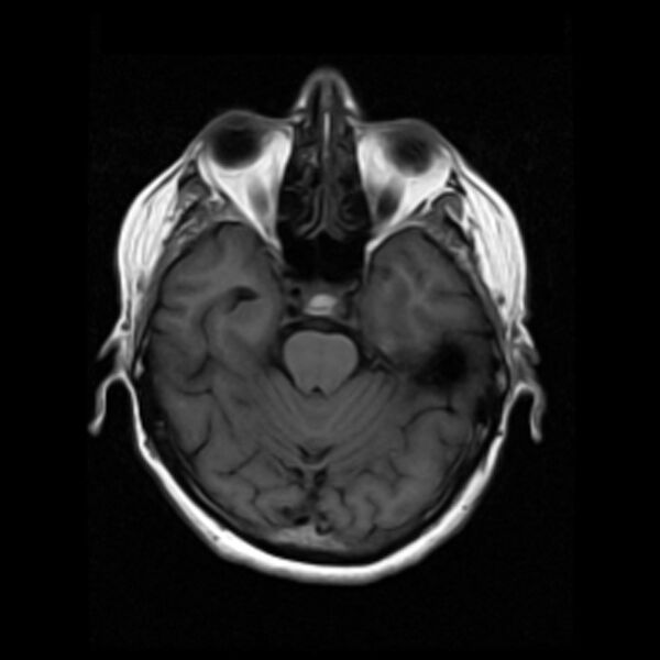 File:Colloid cyst with hydrocephalus (Radiopaedia 9373-10065 Axial T1 6).jpg