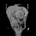 Colocolic fistula - Crohn disease (Radiopaedia 57063-63955 B 12).jpg