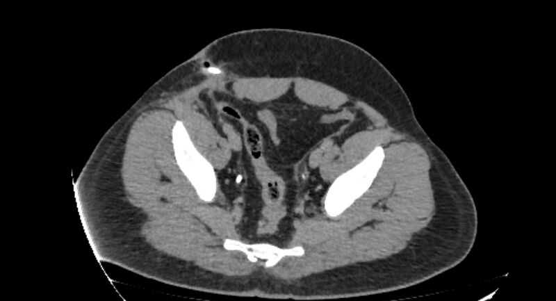 File:Colocutaneous fistula (Radiopaedia 56401-63062 Axial Fistulography 46).jpg