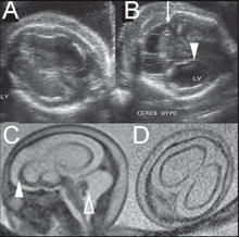 Fetal brain ultrasound scan at 24 weeks gestation: thalamic calcifications, hyperechogenic foci in right ventricular wall, asymmetric ventriculomegaly