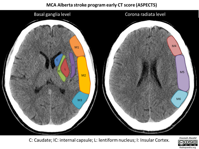 File:MCA - Alberta stroke program early CT score (ASPECTS) illustration (Radiopaedia 72706).png