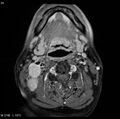 Nasopharyngeal carcinoma (Radiopaedia 4546-6667 Axial T1 C+ fat sat 21).jpg