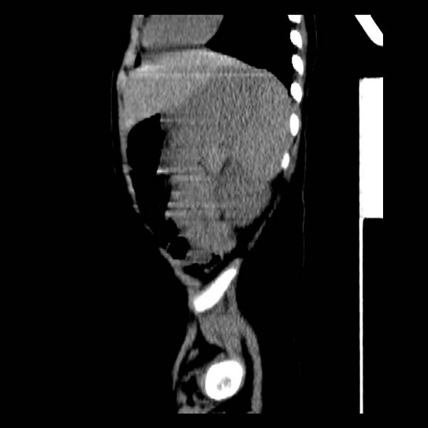 File:Neuroblastoma with skull metastases (Radiopaedia 30326-30960 B 36).jpg