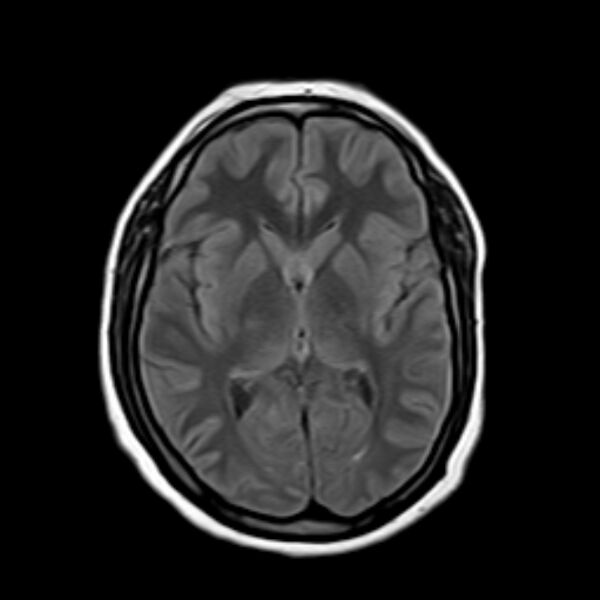 File:Neurofibromatosis type 2 (Radiopaedia 67470-76871 Axial FLAIR 12).jpg