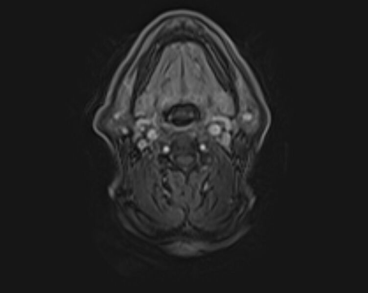 File:Non-Hodgkin lymphoma - parotid gland (Radiopaedia 71531-81890 E 31).jpg