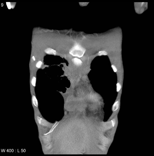 File:Non-Hodgkin lymphoma involving lung (Radiopaedia 29094-29470 C 3).jpg