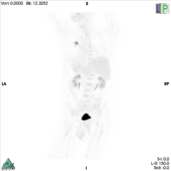 File:Non-Hodgkin lymphoma involving seminal vesicles with development of interstitial pneumonitis during Rituximab therapy (Radiopaedia 32703-33752 PET cor 3D MIP 6).jpg